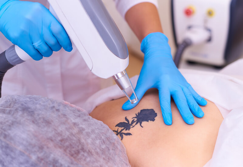 Tattoo Removal